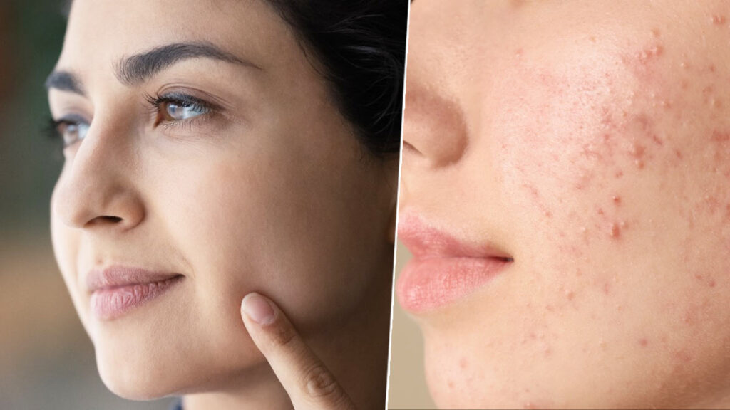 ऑयली स्किन पर रहती है पिंपल्स की समस्या, इस घरेलू तरीके को अपनाकर तुरंत मिलेगा छुटकारा