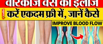 Varicose Veins Treatment in Hindi: अब बिना पैसों के भी होगा सटीक ईलाज