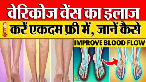 Varicose Veins Treatment in Hindi: अब बिना पैसों के भी होगा सटीक ईलाज