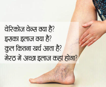 Varicose Veins Treatment in Meerut: नसों के गुच्छे का Best समाधान मात्र 3 घंटे में