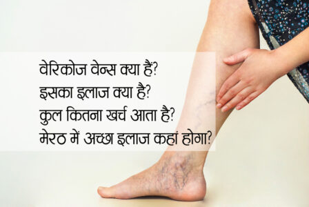 Varicose Veins Treatment in Meerut: नसों के गुच्छे का Best समाधान मात्र 3 घंटे में