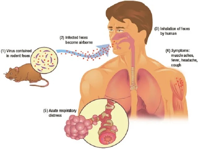 Hanta Virus